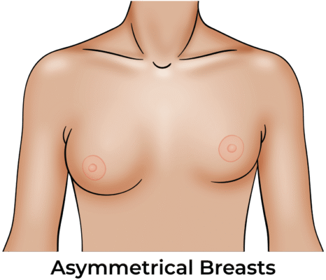 Гулька на грудях у дитини 9 років: причини, симптоми та лікування