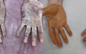 Іонофорез від гіпергідрозу: ефективне лікування підвищеної пітливості