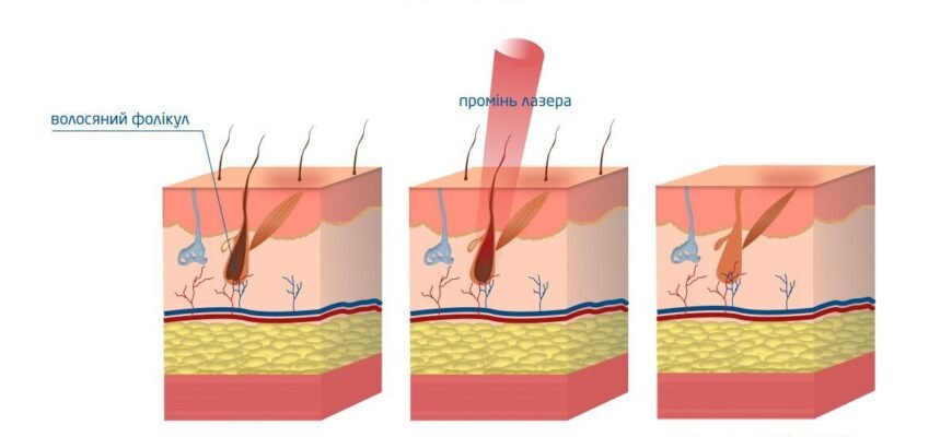 Кількість сеансів лазерної епіляції: скільки потрібно для ідеальної шкіри?