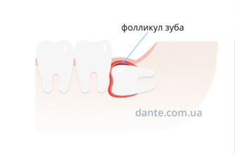 Коли та чому треба видаляти зуби мудрості: корисні поради від фахівців