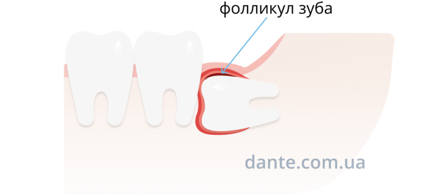 Коли та чому треба видаляти зуби мудрості: корисні поради від фахівців