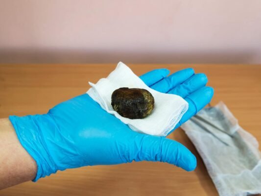 Коли та навіщо необхідно видаляти жовчний міхур: основні показання