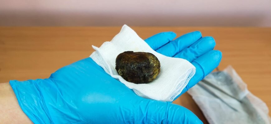 Коли та навіщо необхідно видаляти жовчний міхур: основні показання