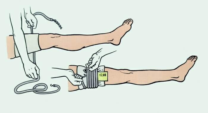 Правила накладання джгута