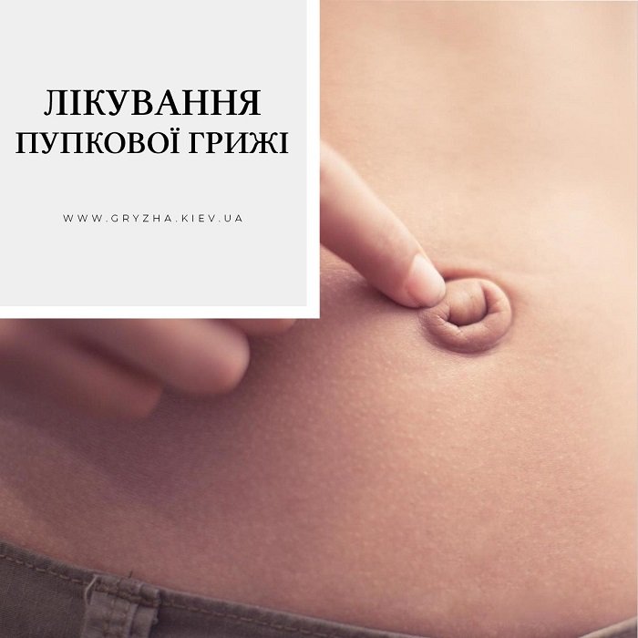 Пупкова грижа: симптоми, діагностика та лікування у клініці ...