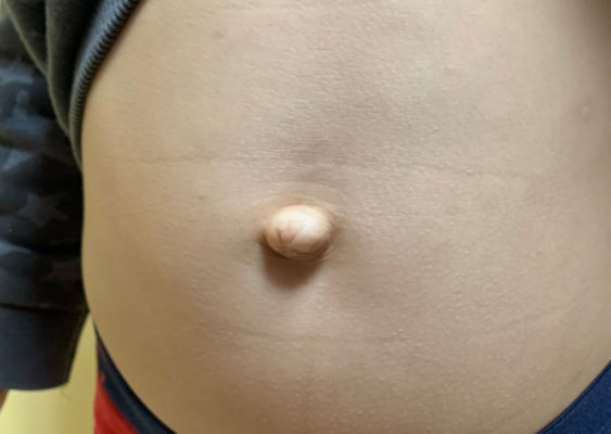 Пупкова грижа у дітей 6 років: причини, симптоми та лікування