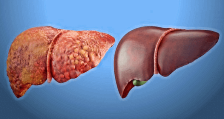 Скільки часу потрібно для відновлення печінки після алкоголю та ...