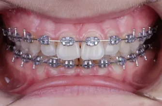Скільки часу потрібно носити брекети для досягнення ідеальної усмішки?