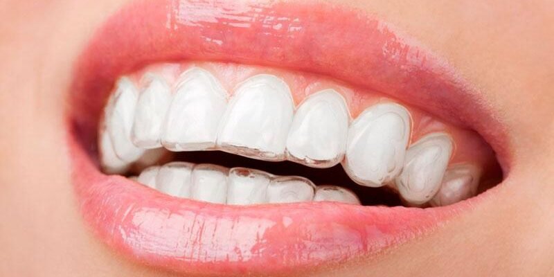 Скільки часу потрібно носити капу після брекетів: поради ортодонтів