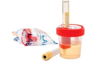 Скільки потрібно сечі для загального аналізу: докладна інструкція.