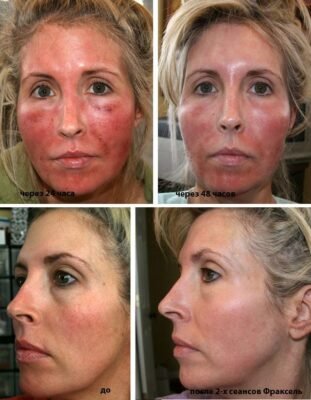 Скільки процедур карбонового пілінгу потрібно для максимального ефекту?