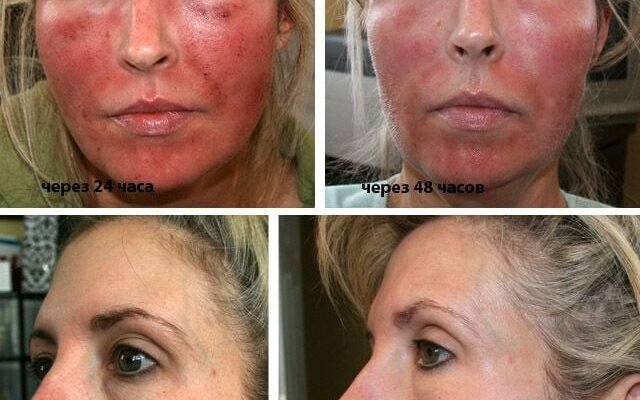 Скільки процедур карбонового пілінгу потрібно для максимального ефекту?