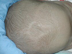 Гідроцефалія або водянка головного мозку: що треба знати про ...