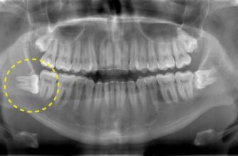 В якому віці зазвичай з’являються зуби мудрості: ключові факти
