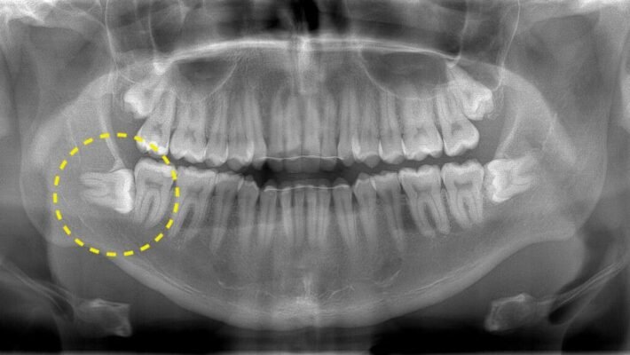 В якому віці зазвичай з’являються зуби мудрості: ключові факти