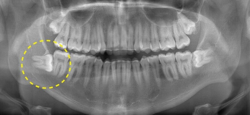 В якому віці зазвичай з’являються зуби мудрості: ключові факти