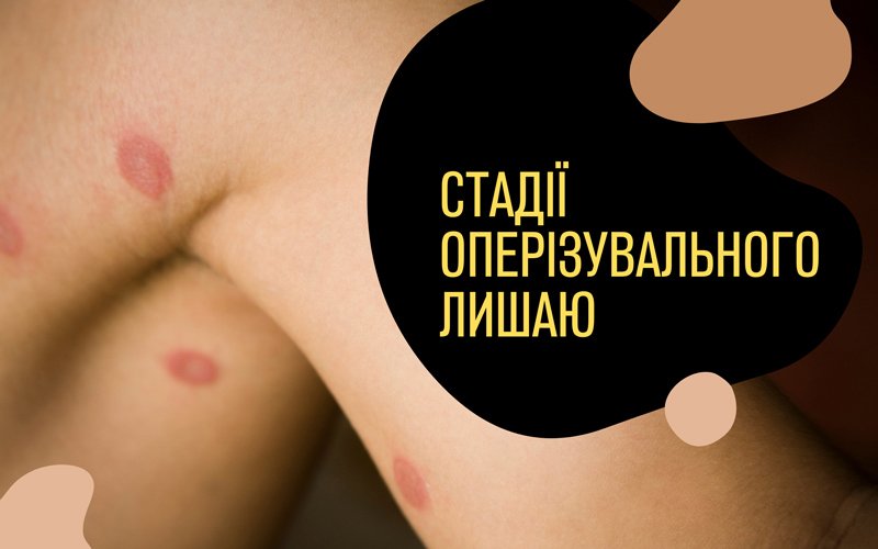 Оперізуючий лишай: причини, симптоми, лікування - FitoBlog