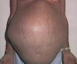 Висипи на шкірі: як проблеми з печінкою впливають на вашу шкіру