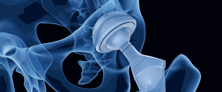 Вивих головки ендопротезу кульшового суглоба