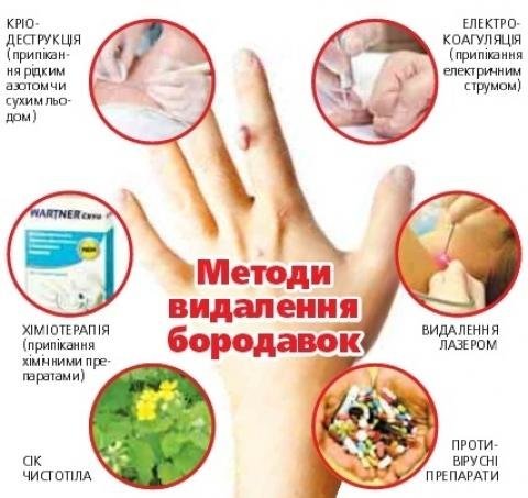 Що таке бородавка: види, причини, симптоми, лікування | МЦ Лазерсвіт