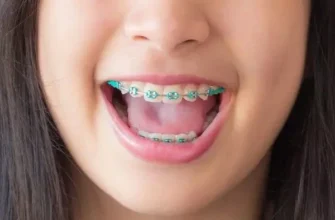 З якого віку можна встановлювати брекети: професійні рекомендації