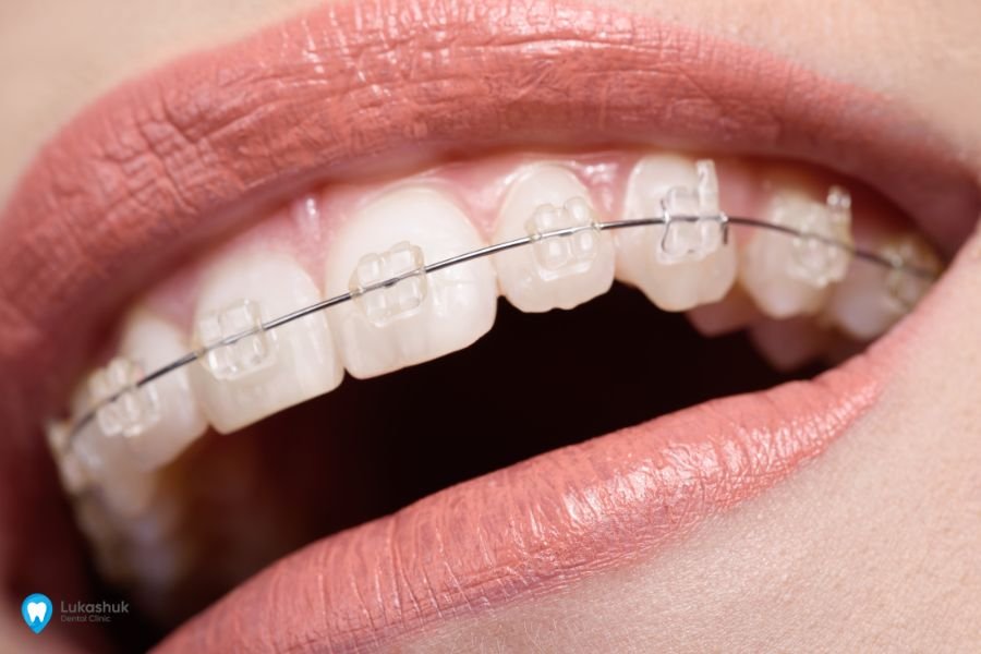 Брекети у дорослому віці: до скільки років можна ставити