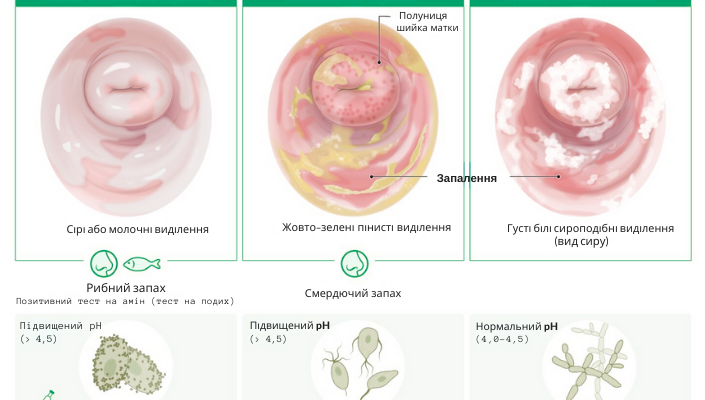 Жовті виділення у дівчинки 5 років: причини та що робити батькам