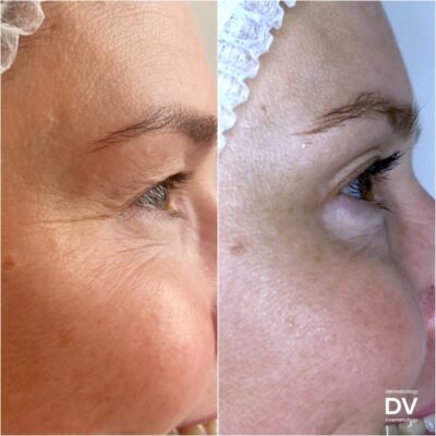 Ботокс: Від чого допомагає та як діє на вашу зовнішність?