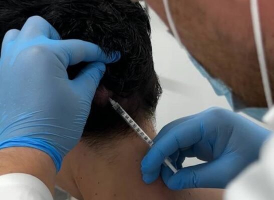 Ботокс від мігрені: яка ціна процедури та її ефективність?