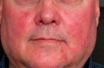 Червоні плями на обличчі від алкоголю: причини та способи лікування
