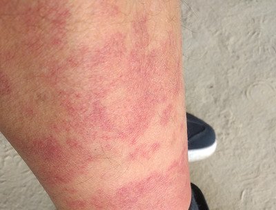 Червоний сверблячий висип на шкірі - алергія чи хвороба?