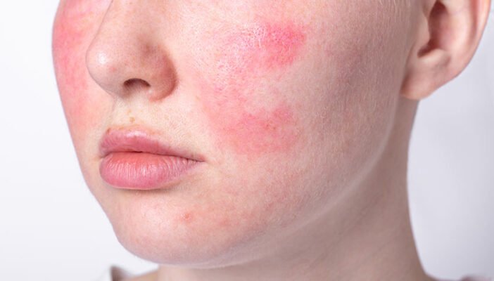 Червоні плями на обличчі від нервів: причини та лікування ефективно Червоні плями на обличчі від нервів: причини та лікування ефективно