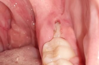 Чи може зуб мудрості викликати біль у горлі: аналіз симптомів і причин