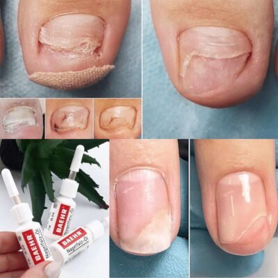 Ефективна мазь для лікування оніхолізису: поради і рекомендації Ефективна мазь для лікування оніхолізису: поради і рекомендації