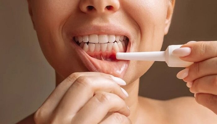 Ефективна мазь від стоматиту: як обрати найкращий засіб для лікування