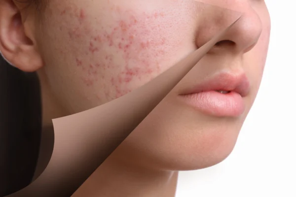 Ефективне лікування акне: як ретиноїди допомагають позбутися прищів Ефективне лікування акне: як ретиноїди допомагають позбутися прищів