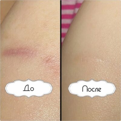 Ефективне лікування рубців: обираємо силіконові пластирі для шкіри