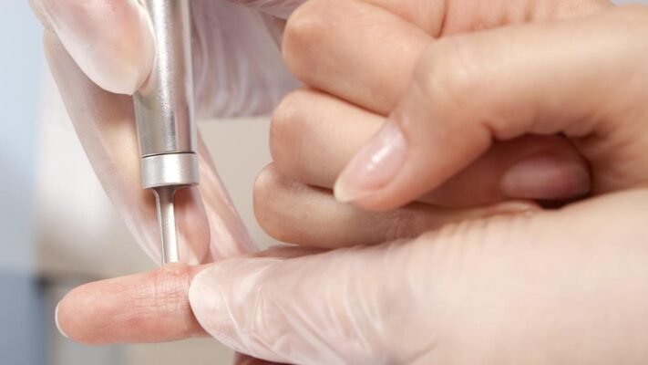 Ефективне лікування: Як рідкий азот допомагає позбутися бородавок