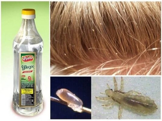 Ефективне використання дустового мила для боротьби з вошами у дітей