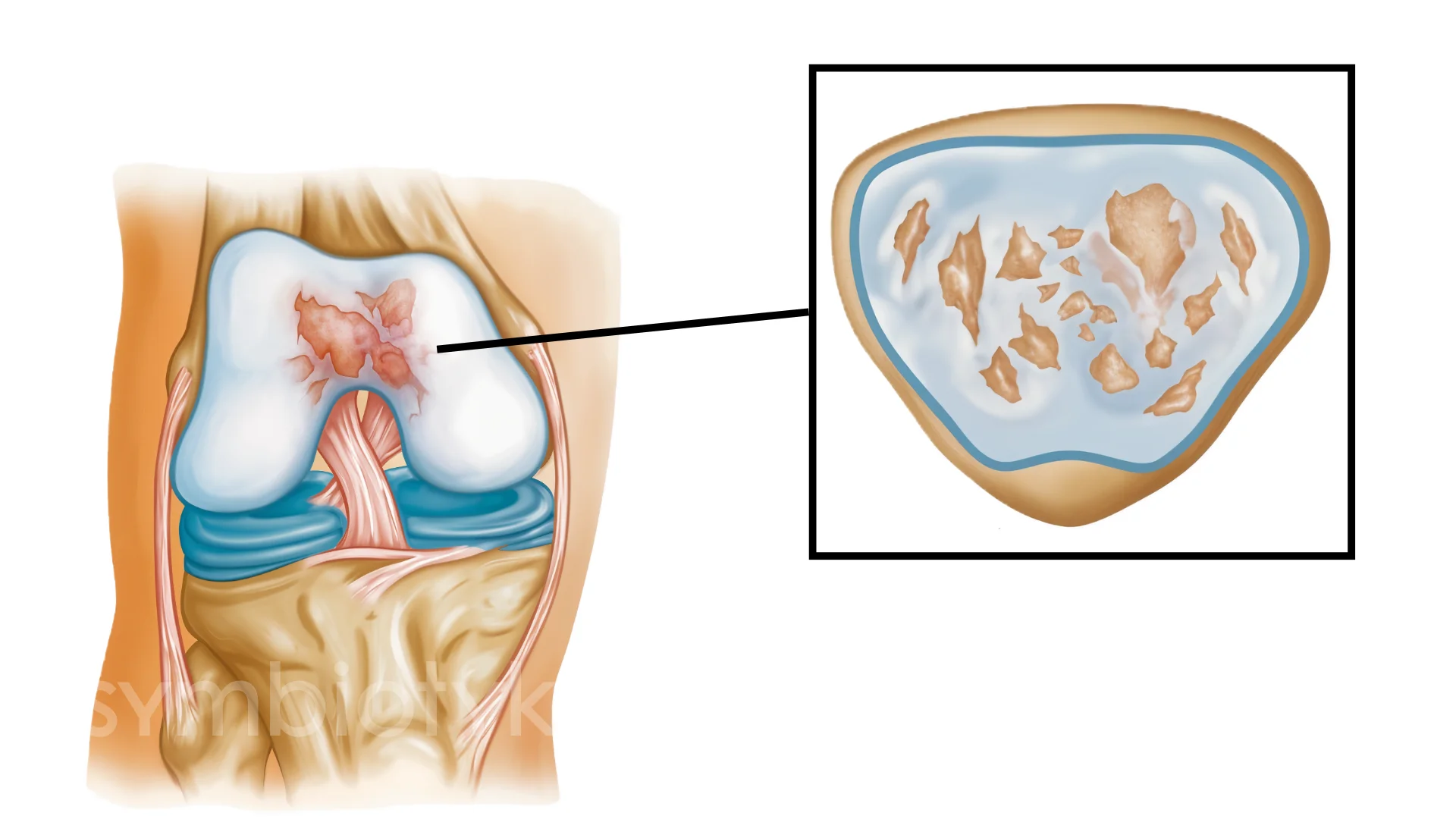 Патело-феморальний артроз: причини, симптоми, діагностика та ...