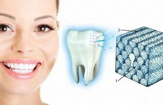 Ефективні капи для захисту зубів від бруксизму: огляд та поради