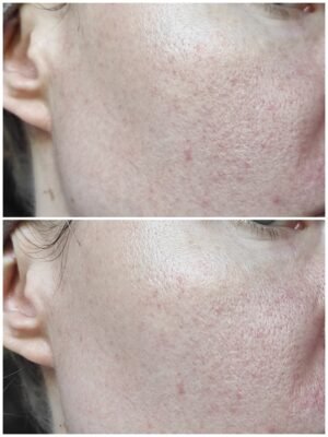 Ефективні креми від розацеа: як вибрати найкращий засіб для шкіри