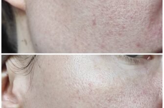 Ефективні креми від розацеа: як вибрати найкращий засіб для шкіри