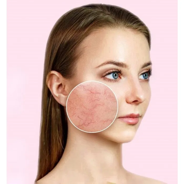 ᐉ Розацеа: причини появи та методи лікування розацеа