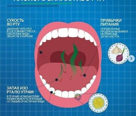 Ефективні ліки від неприємного запаху з рота: огляд та рекомендації