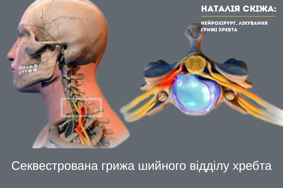 Екструзія шийного відділу хребта – що це, симптоми та сучасне ...