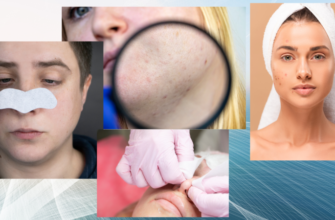 Ефективні методи боротьби з комедонами: поради для чистої шкіри