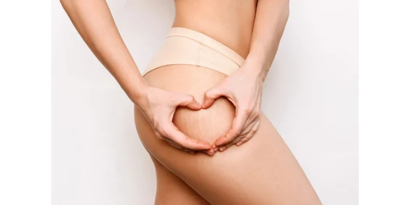 Ефективні методи боротьби з целюлітом: що дійсно допомагає?