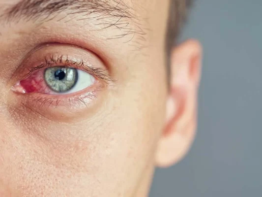 Ефективні методи лікування червоного ока після удару: поради експертів
