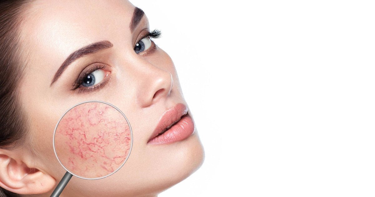 Купероз на обличчі: методи боротьби — Косметологія